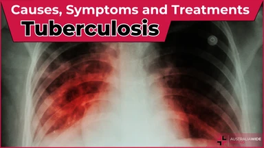 Tuberculosis article header – First Aid Article in Belmont
